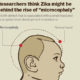 ဇီကာဗိုင်းရပ်စ် ကူးစက်ခံရမှုနှင့် မွေးရာပါ ဦးခေါင်းသေးရောဂါ ဆက်စပ်လျက်ရှိ (အင်တာနက်)