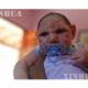မွေးရာပါ ဦးခေါင်းသေးရောဂါ ဖြစ်ပွားနေသော ကလေးငယ် တစ်ဦးအား တွေ့ရစဉ် (ဆင်ဟွာ)
