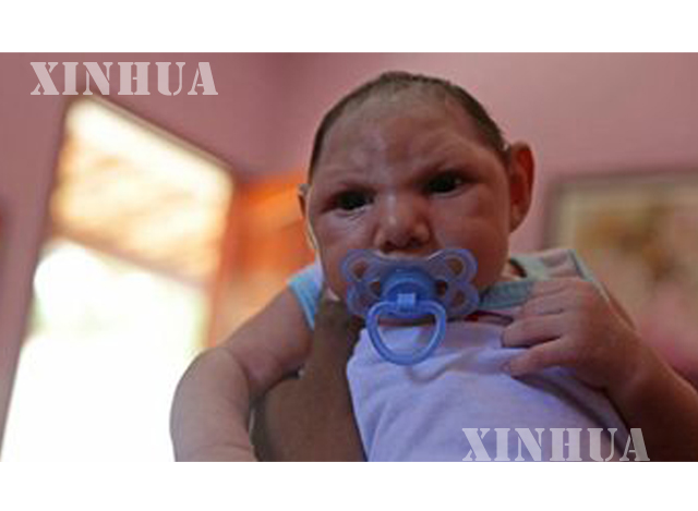 မွေးရာပါ ဦးခေါင်းသေးရောဂါ ဖြစ်ပွားနေသော ကလေးငယ် တစ်ဦးအား တွေ့ရစဉ် (ဆင်ဟွာ)