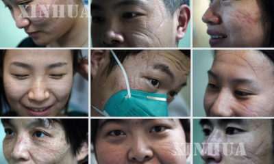 တရုတ်နိုင်ငံ၌ နိုဗယ်လ်ကိုရိုနာဗိုင်းရပ်စ်ကုသရေး ဆောင်ရွက်နေသော ဆေးဝန်ထမ်းများ၏ မျက်နှာပေါ်တွင် နှာခေါင်းစည်းအရာများ ထင်ကျန်နေပုံကို တွေ့ရစဉ်(ဆင်ဟွာ)
