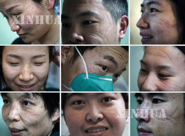 တရုတ်နိုင်ငံ၌ နိုဗယ်လ်ကိုရိုနာဗိုင်းရပ်စ်ကုသရေး ဆောင်ရွက်နေသော ဆေးဝန်ထမ်းများ၏ မျက်နှာပေါ်တွင် နှာခေါင်းစည်းအရာများ ထင်ကျန်နေပုံကို တွေ့ရစဉ်(ဆင်ဟွာ)